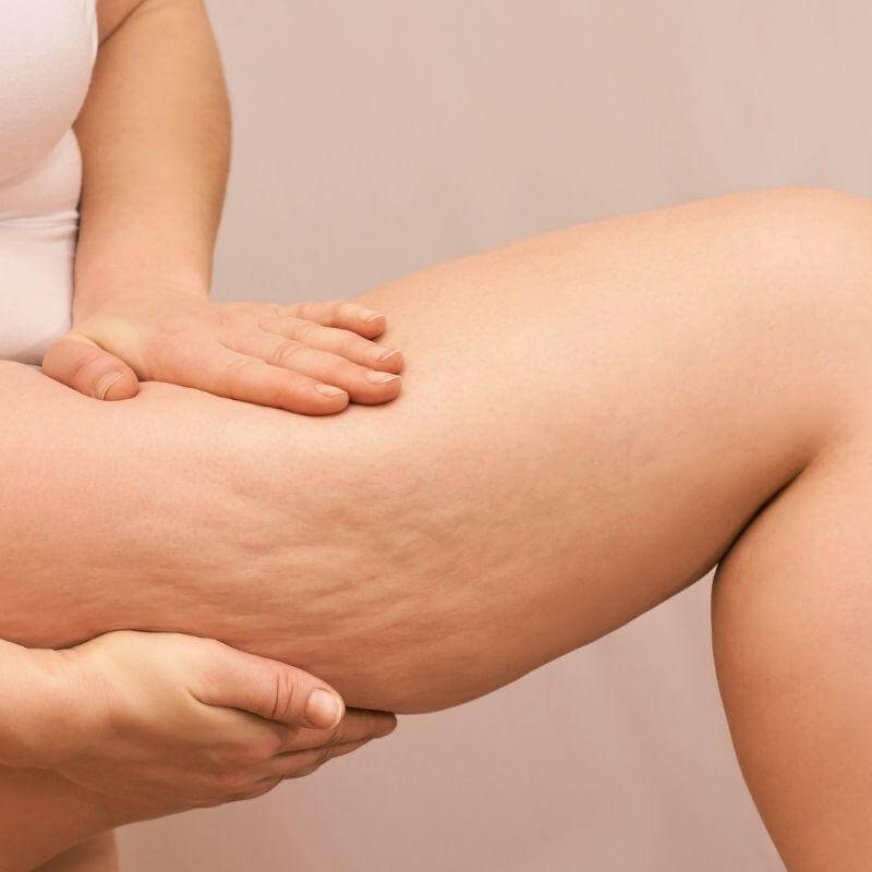 FAIRE DISPARAITRE LA CELLULITE, EST-CE REALISABLE ?